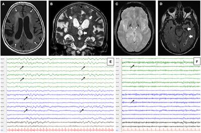 Case Report: Presence of Anti-MAG in the CSF Can Be Associated With a Neurodegenerative Process With Frontal Involvement